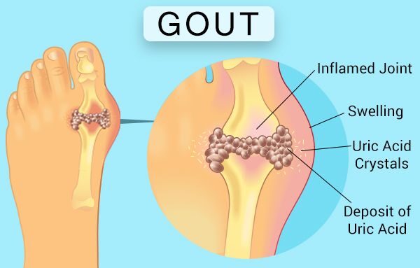 Gout Treatment
