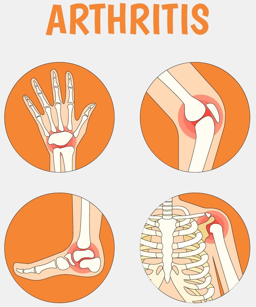 Arthritis Treatment