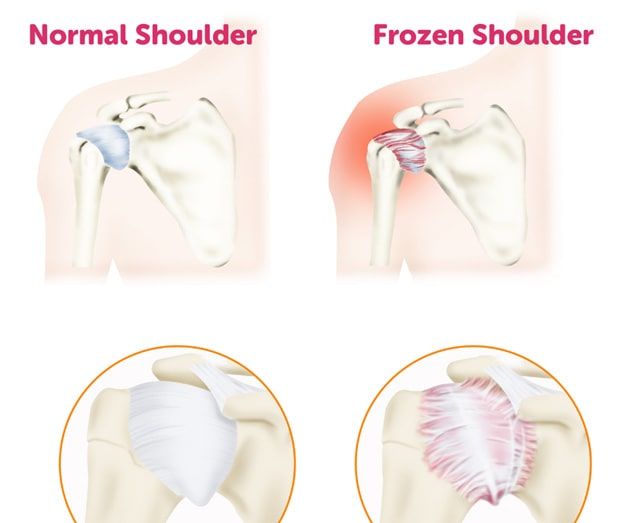 Frozen Shoulder Treatment